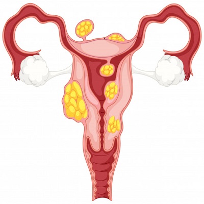 Uterine Fibroids Problem