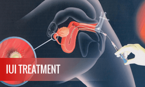 IUI Treatment India | The Bliss Care Clinic